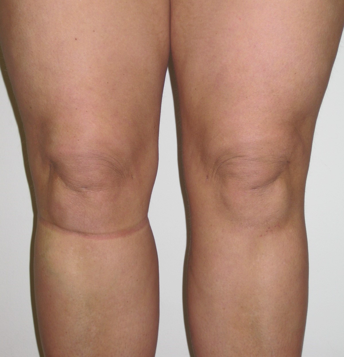 How To Lose Weight in Your Knees